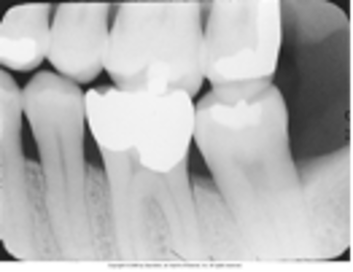 <p>What does a negative vertical angulation of the PID cause in a bitewing image?</p>