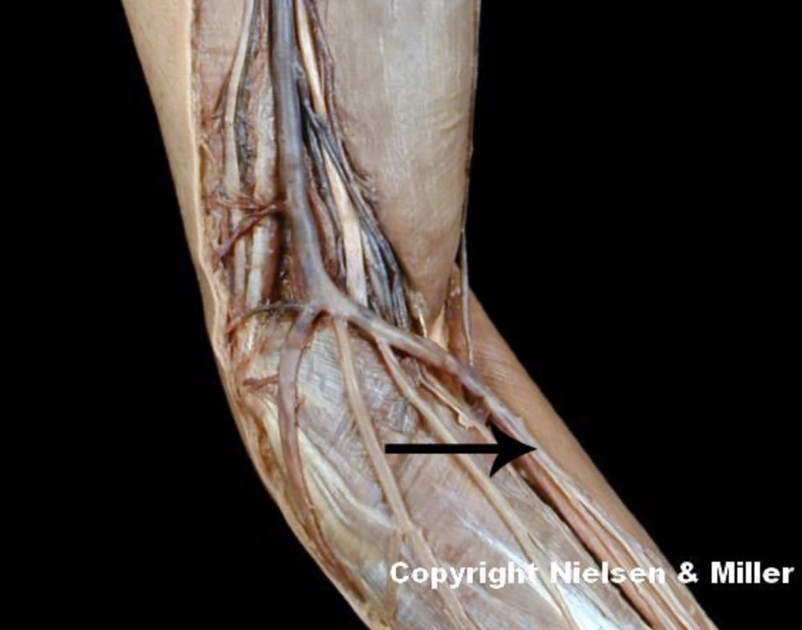 <p>The indicated vessel is the _ (anteromedial view of superficial veins of arm/forearm). It drains the integumentary and superficial muscles of the _ aspect of the upper limb</p>