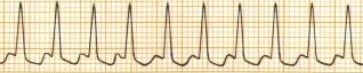 <p>22/T3</p><p>Rhythm strip (HR 200, Regular, No P)</p><ol><li><p>Asystole</p></li><li><p>Atrial flutter</p></li><li><p>Atrial tachycardia</p></li><li><p>Atrial fibrillation</p></li></ol><p></p>