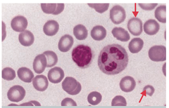 <p>iron deficiency anemia, thalassemia</p>
