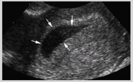<ul><li><p><span style="background-color: transparent;">Pseudogestational sacs</span></p></li><li><p><span style="background-color: transparent;">Corpus luteum cyst vs. adnexal ectopic both have ring of fire appearance</span></p><ul><li><p><span style="background-color: transparent;">Corpus luteum cyst - more hypoechoic</span></p></li><li><p><span style="background-color: transparent;">Adnexal ectopic - echogenic decidual donut</span></p></li></ul></li></ul><p></p>