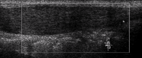 <p><span style="background-color: transparent;">Progressive degeneration of tendon tissues → fraying/damage to tissue → tendon thickening</span></p>