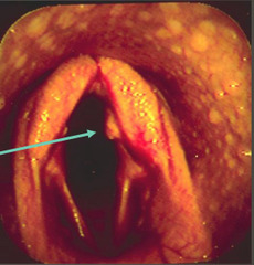 <p>What is this, causing arytenoid chondritis?</p>