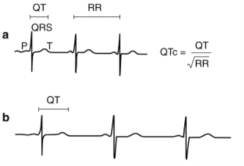 <p>What is Long QT syndrome?</p>
