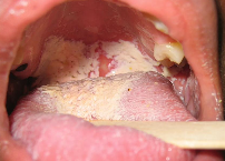 <p>distinct white patches that can be <span style="color: red;">wiped off easily</span> exposing an <span style="color: red;">underlying erythematous surface</span></p>
