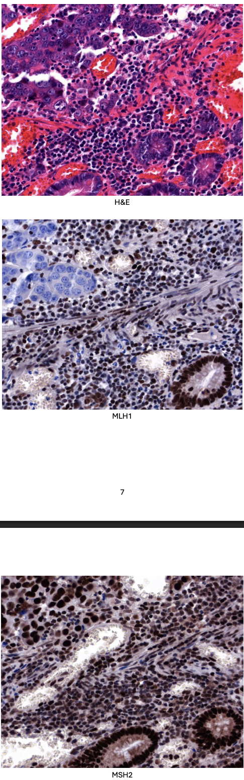 <p>Biopsy tissue was sent to the histopathology department for analysis and a moderately differentiated adenocarcinoma was diagnosed. Immunohistochemistry for MLH1 and MSH2 was performed, and the results are shown below. (Positive staining for MLH1 and MSH2 is brown.) </p>