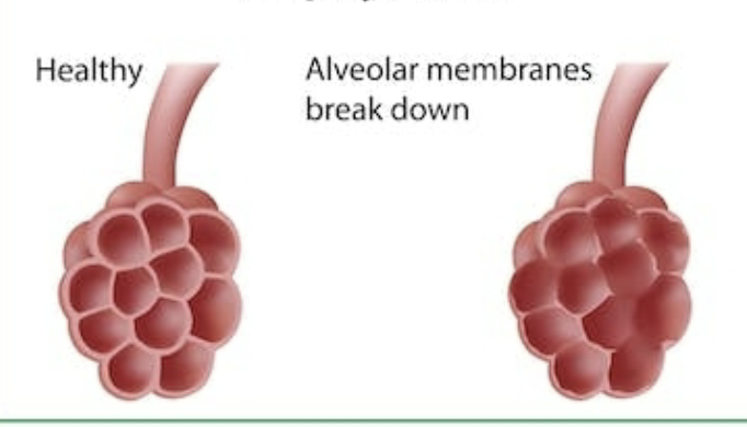 <p>what copd is shown in this image?</p>