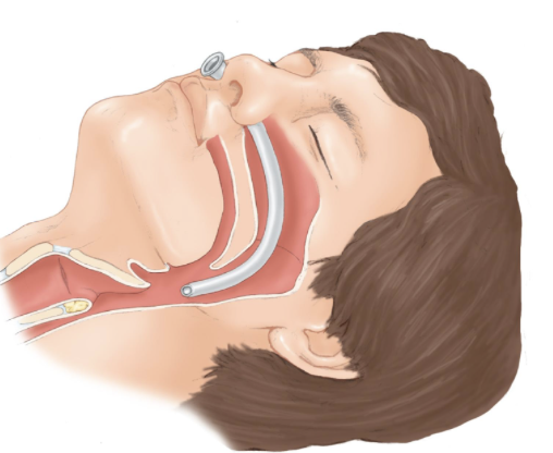 <p><span style="background-color: transparent;"><em>If one adjunct, positioning, and airway maneuvers are not sufficient, you may combine them</em></span></p>