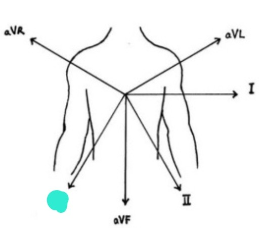 <p>left arm &amp; left leg 흘러가는 전기적 흐름 보여줌</p>