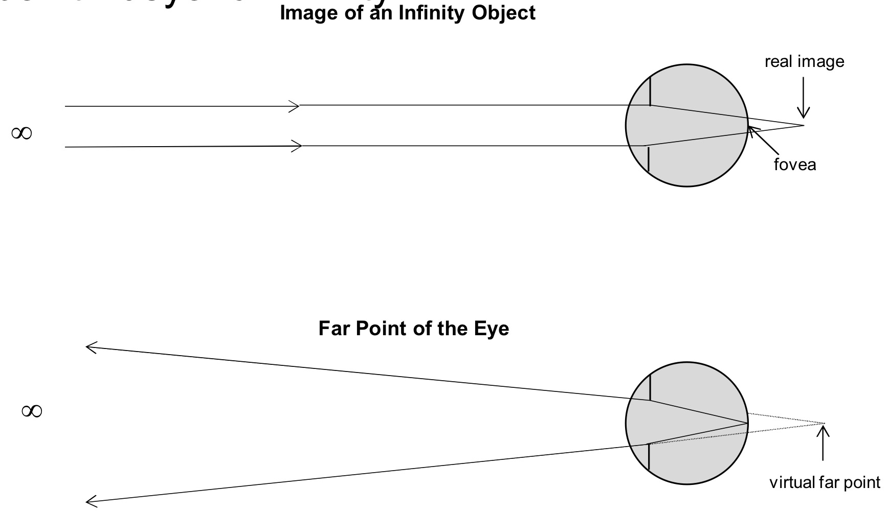 <p>far-sighted, plus lenses needed</p><p>Image point: behind the retina/ “behind the eye”; Far</p><p>point: “beyond” infinity</p>