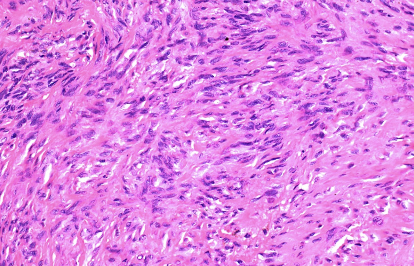 <p>nodules face palamaire tendons fléchisseurs main </p><p>1) diagnostic</p><p>2) nom palamaire, plantaire et penis</p><p>3) moléculaire</p>