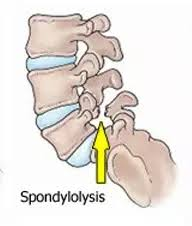 <p>A spondylolysis is a fracture of which part of the vertebrae?</p>