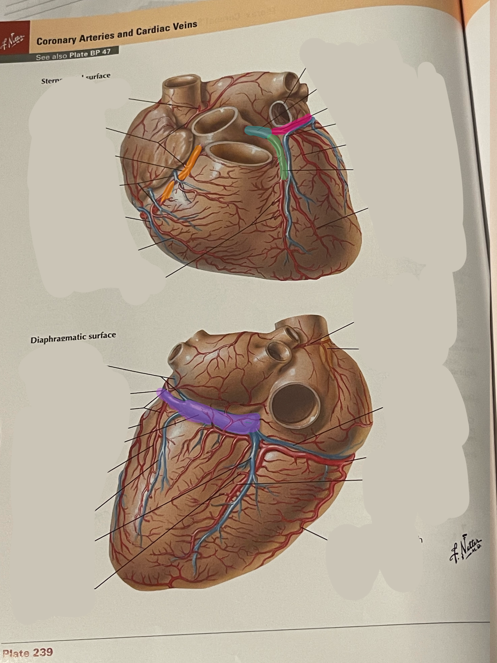 <p>Anterior inner ventricular artery</p>