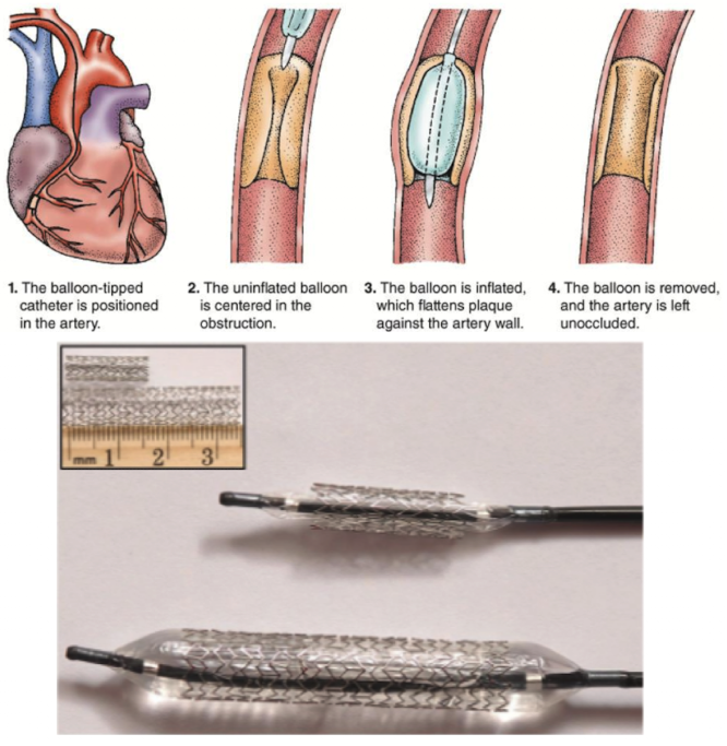 <ol><li><p>catheter advanced into vessel</p></li><li><p>hemodynamic pressures recorded proximally/distally to area of stenosis</p></li><li><p>angiogram to assess extent of blockage</p></li><li><p>angiogram after blockage is cleared</p></li><li><p>hemodynamic pressure measured to ensure vessel is patent</p></li></ol><p></p>