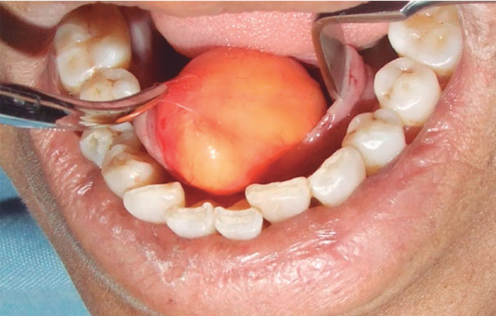 <ul><li><p>benign tumor of fat</p></li><li><p>although rare in the oral/ maxillofacial area, the lipoma is the most common mesenchymal neoplasm </p></li><li><p>unrelated to metabolism/ body fat</p></li><li><p>F>M</p></li><li><p>soft nodule, most</p></li><li><p>commonly involving the buccal mucosa</p></li><li><p>normal or yellow in color </p></li></ul><p></p>