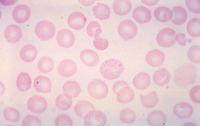 <p>what hemoglobinopathy is this? what inclusion is present?</p>