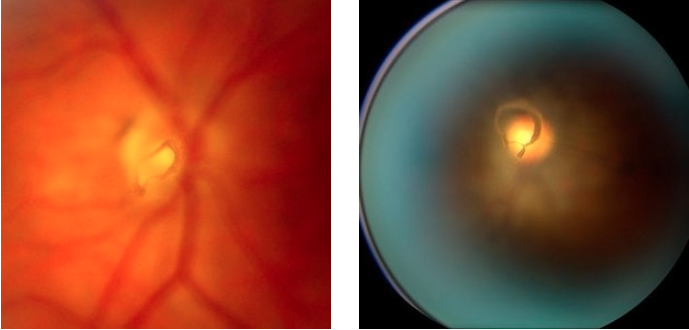 <p>PP: gel surface that attaches on to retina (vitreous)→detaches from retina</p><p>CM: asx<br>or<br>floaters<br>flashes of light</p><p>DX: discrete translucent/broken circle shaped opacity near optic disc<br>retinal break (8-10%)→dilated eye exam</p>