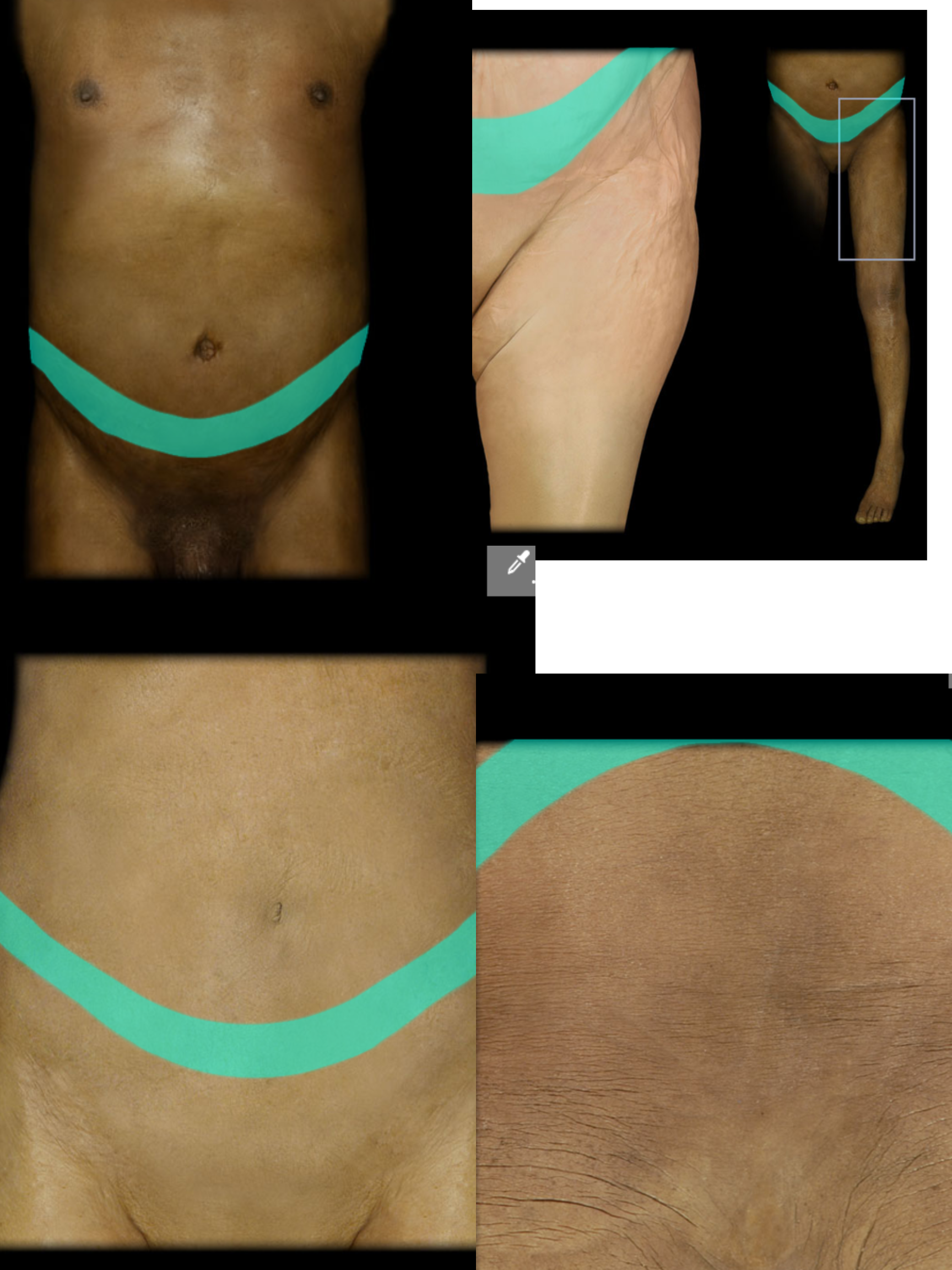 <p>T12 Dermatome</p>