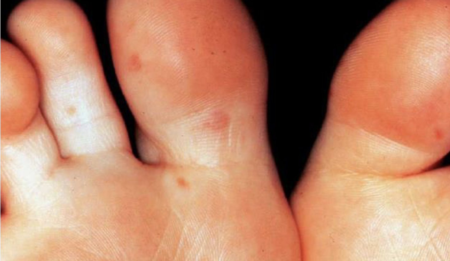 <p>what are these lesions associated with</p>