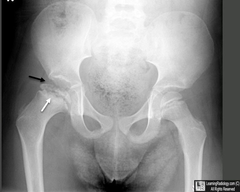 <p>The most common type of aseptic or ischemic necrosis, Lesions typically involve one hip (head and neck of femur), Occurs predominantly in 5-10 year old boys, Limp is first clinical sign</p>