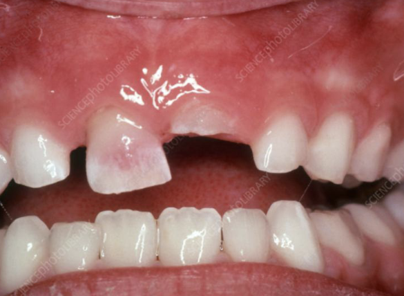 <p>what is the cause of this lesion </p>