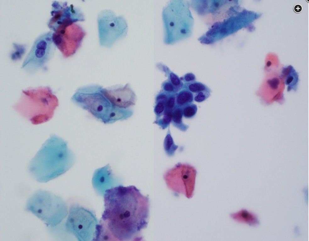 <p>45F pap smear - diagnosis</p>