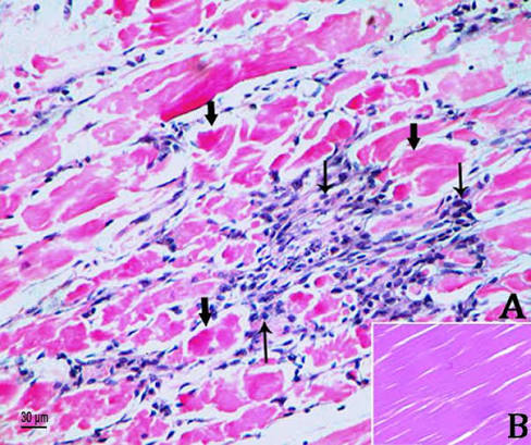 <p>Multifocal skeletal muscle necrosis</p>