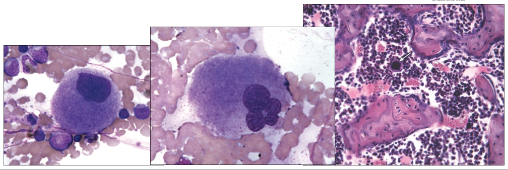 <ul><li><p>Thrombopoiesis—platelet production</p><ul><li><p>Megakaryocytes arise in the bone marrow</p><ul><li><p>Develop from megakaryoblasts</p></li><li><p>Large polyploid cells</p></li><li><p>Break off fragments of themselves to form platelets that leave bone marrow and enter periphery</p></li><li><p>Estimated production of 150 billion platelets per day!</p></li></ul></li></ul></li></ul><p></p>