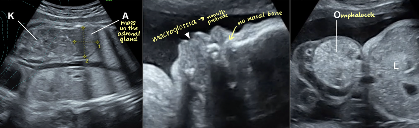 <ul><li><p>large for dates fetus with enlarged kidneys, omphalocele, and <span style="color: red;">macroglossia</span> on 2nd trimester US</p></li><li><p>may have an enlarged spleen, liver, and adrenal glands</p></li></ul><p></p>