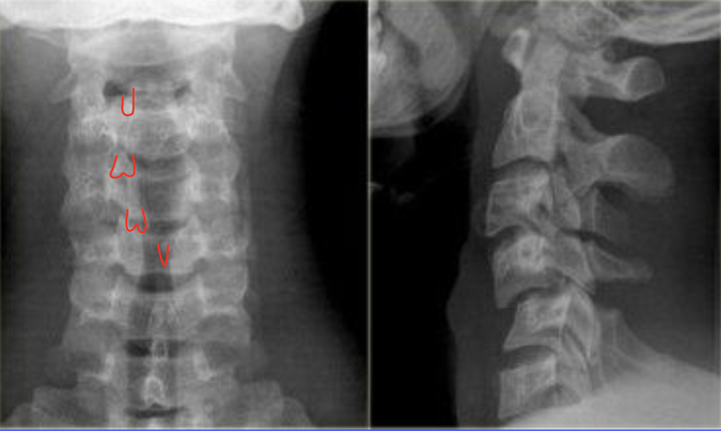 <p>If a patient shows you a CT with a "Inverted Hamburger Sign" what is the likely diagnosis?</p>