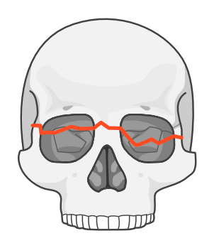 <p>similar to type 2</p><p>lengthening and flattening of face</p><p>orbital hooding</p><p>enophthalmos </p><p>mastoid region bruising</p><p>ear drainage</p><p>hemotympanum</p>