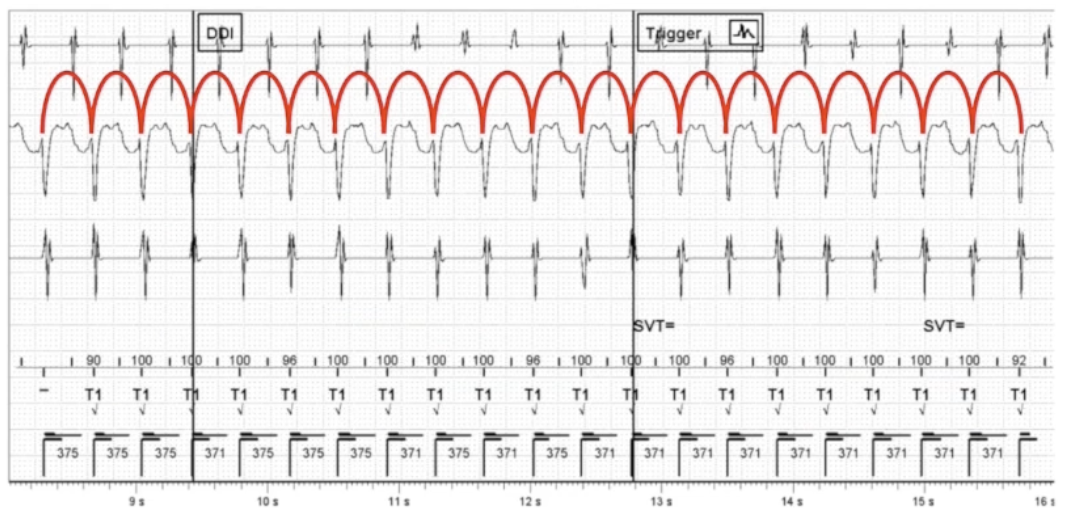 <p>Conduct detailed left to right analysis of markers and IEGMs</p>