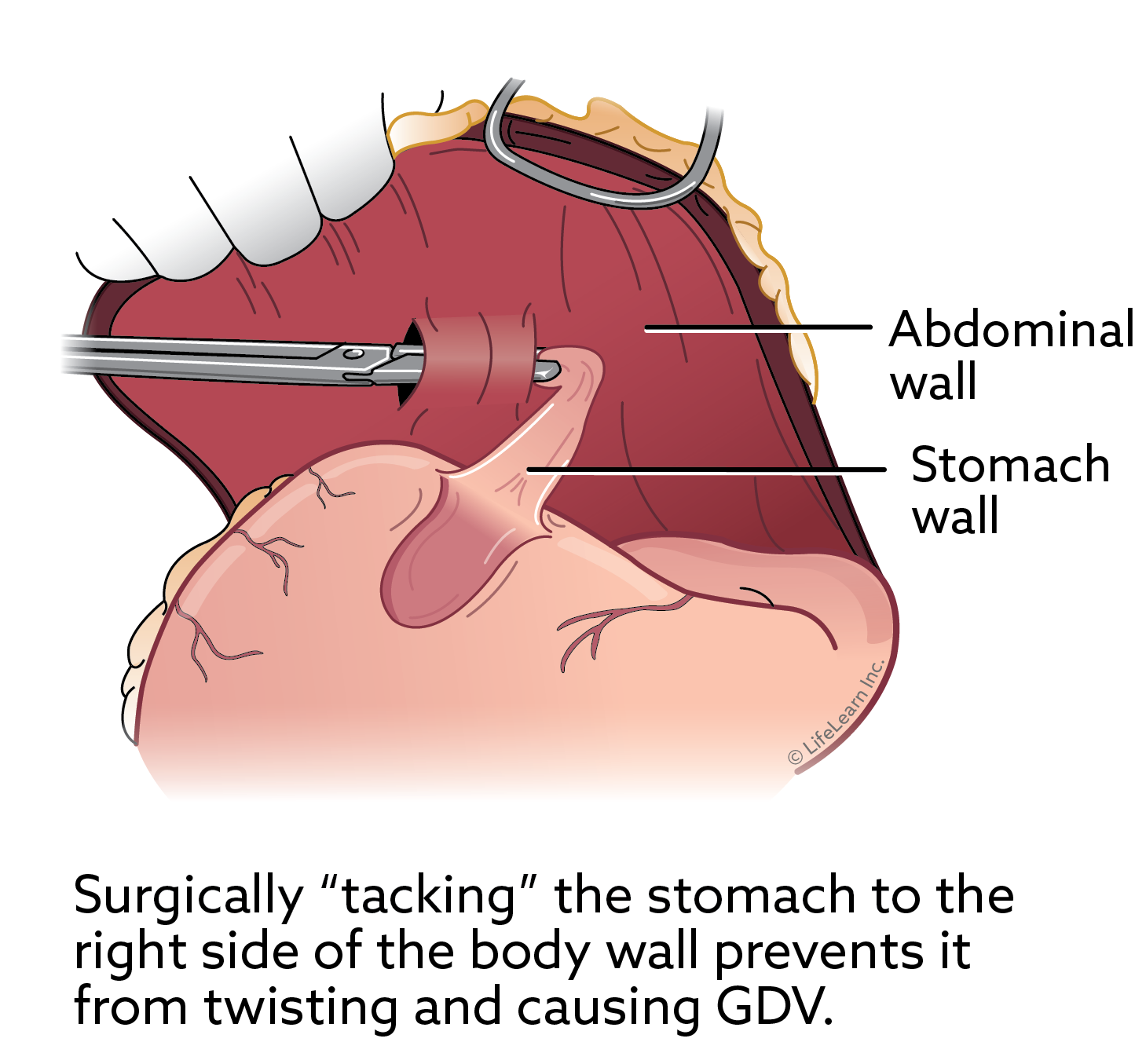 <p>Gastropexy</p>