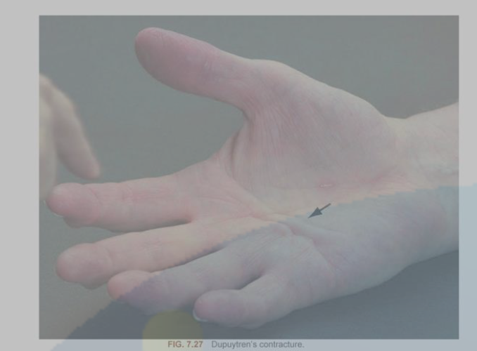 <p>Dupuytren Contracture</p>
