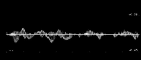 <p>Which of the following statements is true regarding the Doppler tracing displayed? </p><p>a. it could represent a doppler tracing of normal flow in the right hepatic vein</p><p>b. it could represent a doppler tracing of normal flow in the main portal vein</p><p>c. it could represent a doppler tracing of normal flow in the portal or hepatic venous system</p><p>d. it could represent a doppler tracing of normal flow in the proximal aorta</p>