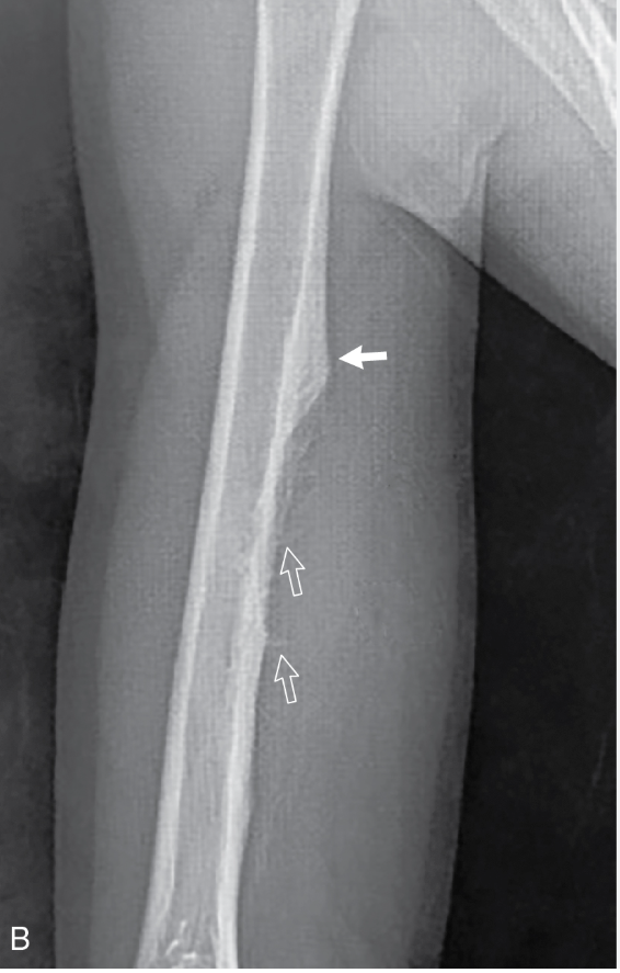 <p>Permeative lesion that causes a multi-paralleled onion skin (laminated) type of periosteal reaction; bone expansion, Codman’s triangle, saucerization </p>