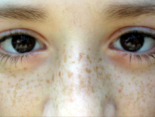 <p><span style="color: red;">brown to black extrinsic</span> pigmentation</p>