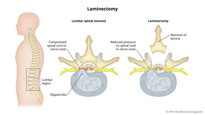 <p>Lamina removal</p>