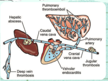 <p>1. Rupture of a hepatic abscess into the caudal vena cava </p><p>2. Vegetative valvular endocarditis involving the tricuspid valve </p><p>3. Jugular thrombosis </p><p>4. Deep vein thrombosis</p>