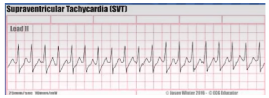 <ul><li><p><span style="background-color: transparent;">Can’t see P waves</span></p></li><li><p><span style="background-color: transparent;">Narrow QRS</span></p></li><li><p><span style="background-color: transparent;">Continues until broken&nbsp;</span></p><ul><li><p><span style="background-color: transparent;">Heart rate: 190bpm</span></p></li><li><p><span style="background-color: transparent;">Rhythm: regular</span></p></li><li><p><span style="background-color: transparent;">P waves: unknown (rhythm too fast)</span></p></li><li><p><span style="background-color: transparent;">PR interval: unknown</span></p></li><li><p><span style="background-color: transparent;">QRS complex: narrow 0.06 seconds</span></p></li></ul></li></ul><p></p>