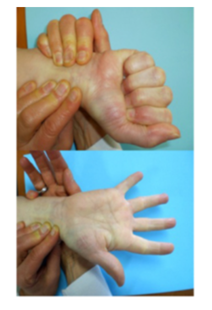 <p>Quin significat té la pal·lidesa persistent del palmell de la mà en aquesta maniobra?</p><p>a) Insuficiència de l’arc palmar superficial</p><p>b) Insuficiència del plexe pampiforme</p><p>c) Insuficiència arterial radial</p><p>d) Insuficiència arterial cubital</p>
