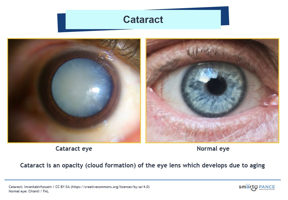 <p>Opacification of the crystalline lens producing gradual painless vision loss, which is the MCC of reversible visual impairment worldwide </p><p>-RF: aging, diabetes, smoking, chronic steroid use, UV exposure, trauma </p><p>-Presentation: gradual painless decreased visual acuity, glare, halos around lights, faded color vision, and second sight. Diminished red reflex, cloudy lens on slit lamp </p><p>-Dx: clinical </p><p>-Tx: early can be managed with glasses, definitive is IOL implantation </p>