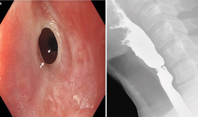 <p>plummer-vinson syndrome cause? features? risk?</p>