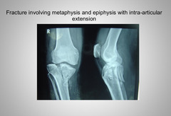 <p>Intra-articular</p>