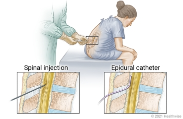 <p>risks associated spinal anesthesia </p>