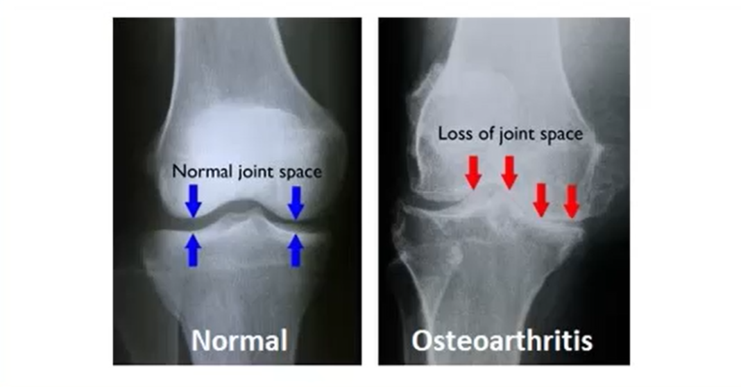 <ul><li><p>Joint stiffness</p><ul><li><p>More common after periods of disuse</p></li></ul></li><li><p>Joint pain</p><ul><li><p><strong>Pain worsens with joint use</strong></p></li></ul></li><li><p>Swelling (depends on stage)</p></li><li><p>Joint effusion</p></li><li><p>Crepitus</p></li><li><p>Bouchard nodes/Herberden nodes</p></li></ul><p></p>