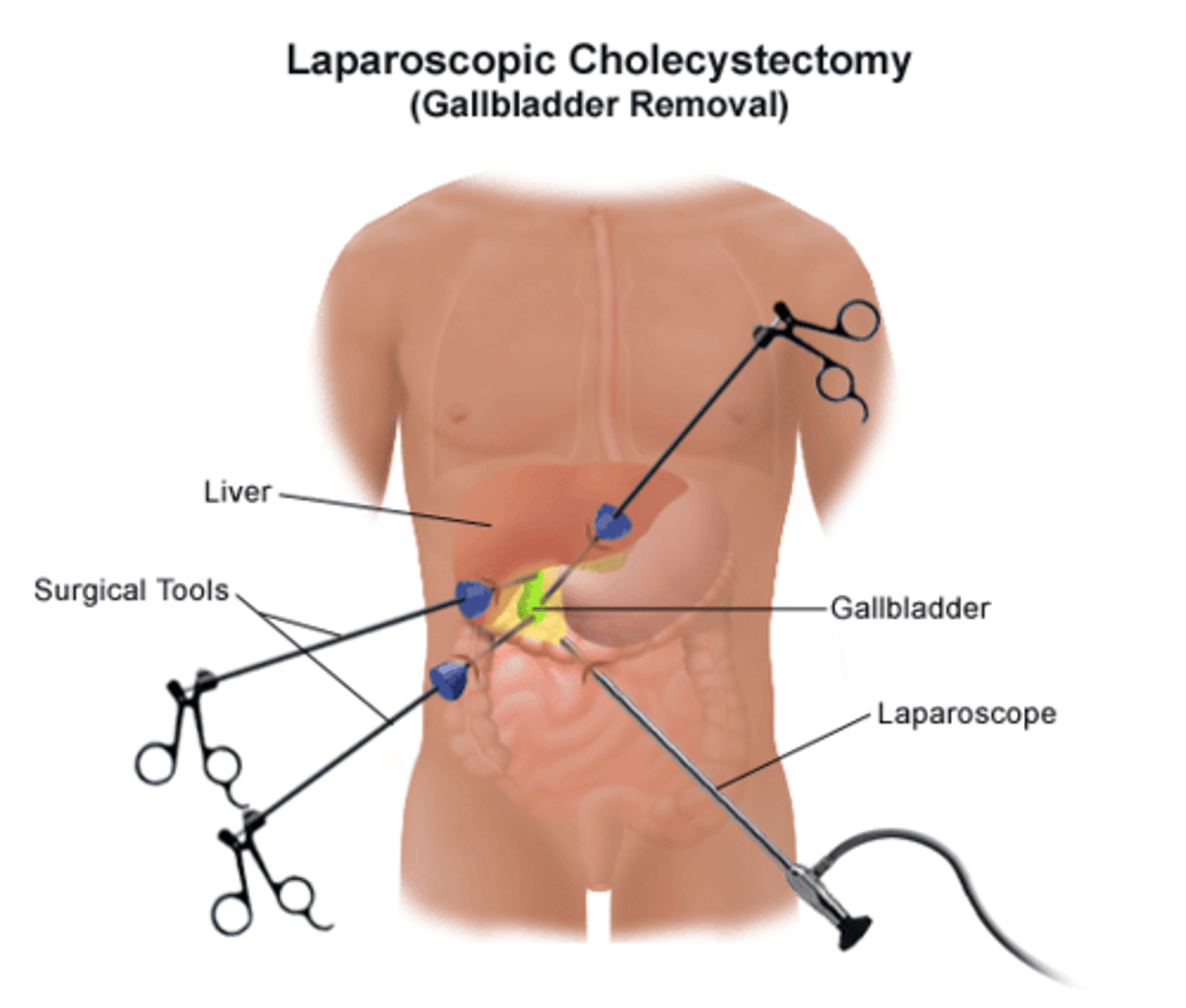 <p>cholecystectomy</p>