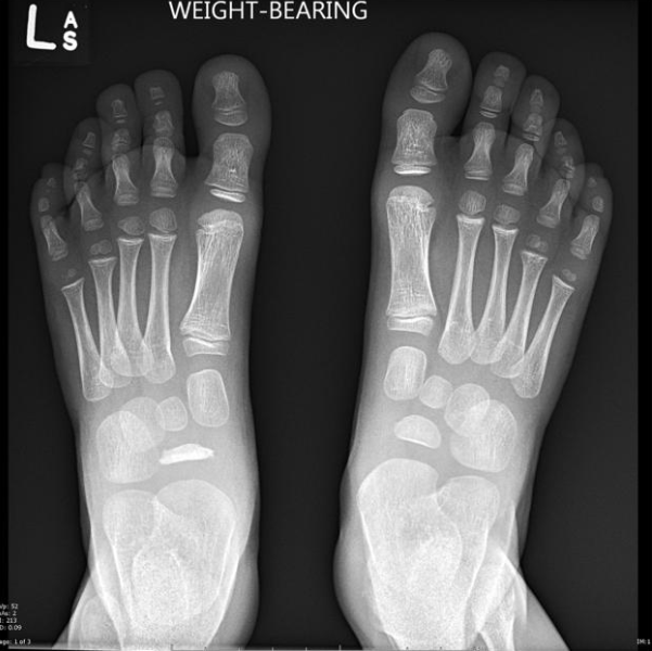 <p>AVN at tarsal navicular </p>