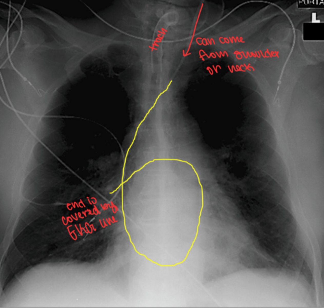 <p>subclavian vein -> SVC -> RA -> RV -> pulmonary artery</p><p>ends just past entrance of right pulmonary artery</p>