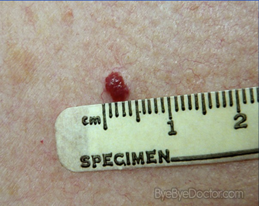 <p>Harmless, age-related red vascular skin lesions.</p>
